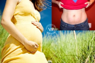 Post Pregnancy Stretch Marks - a worrisome issue for expecting mothers},{Post Pregnancy Stretch Marks - a worrisome issue for expecting mothers