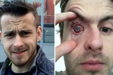 Contact Lens Wearers Beware! Man Goes Blind After Parasites Eat Man&#039;s Eye as He Wore Lenses in Shower