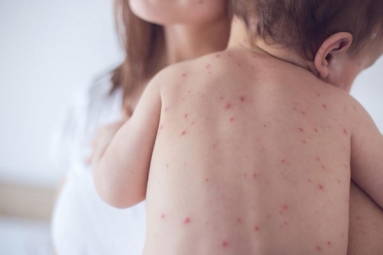Measles Back in the United States as Children Omit Vaccination Doses